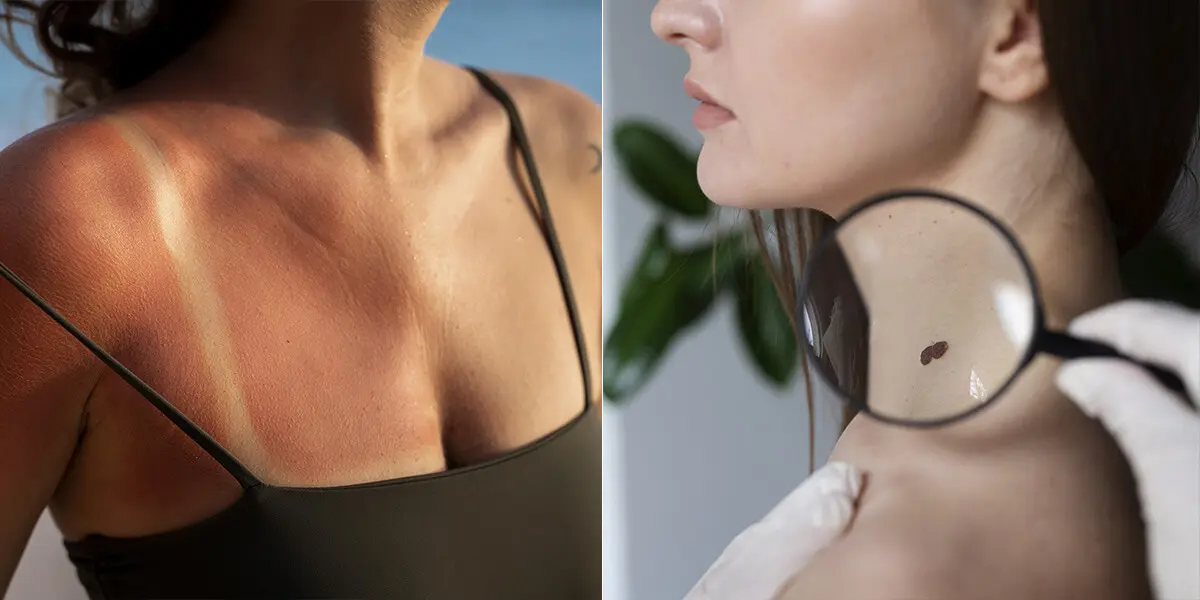 pokožka, spálenie, kontrola, znamienko