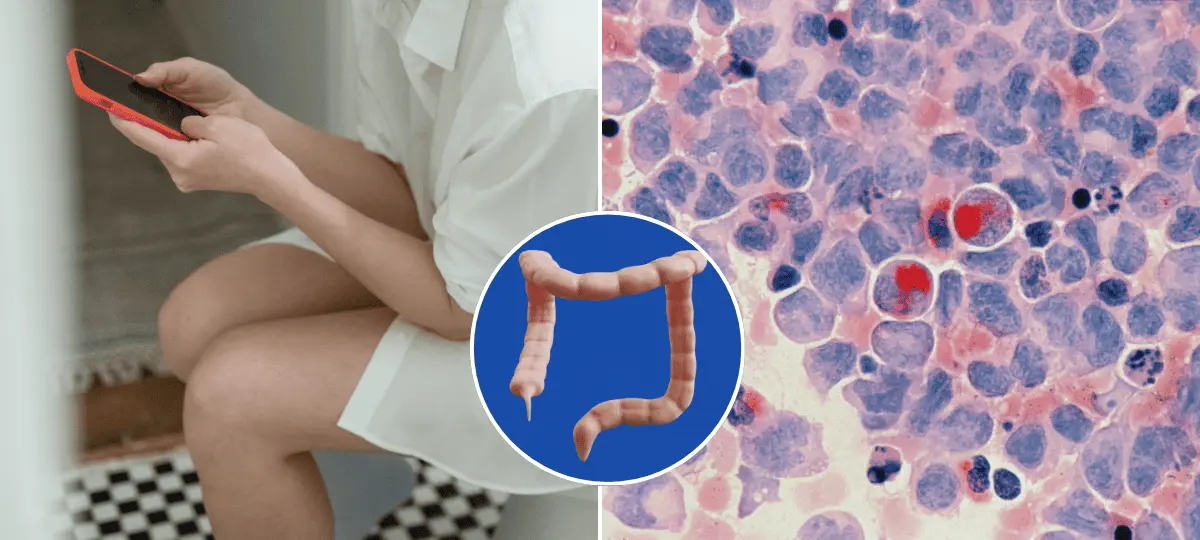 rakovina, hrubé črevo, príznaky