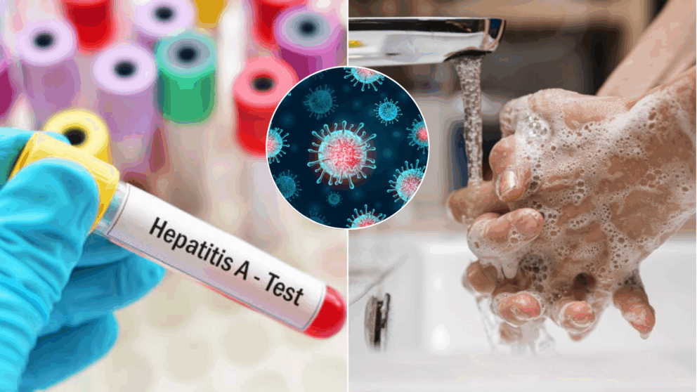 hepatitída-žltačka