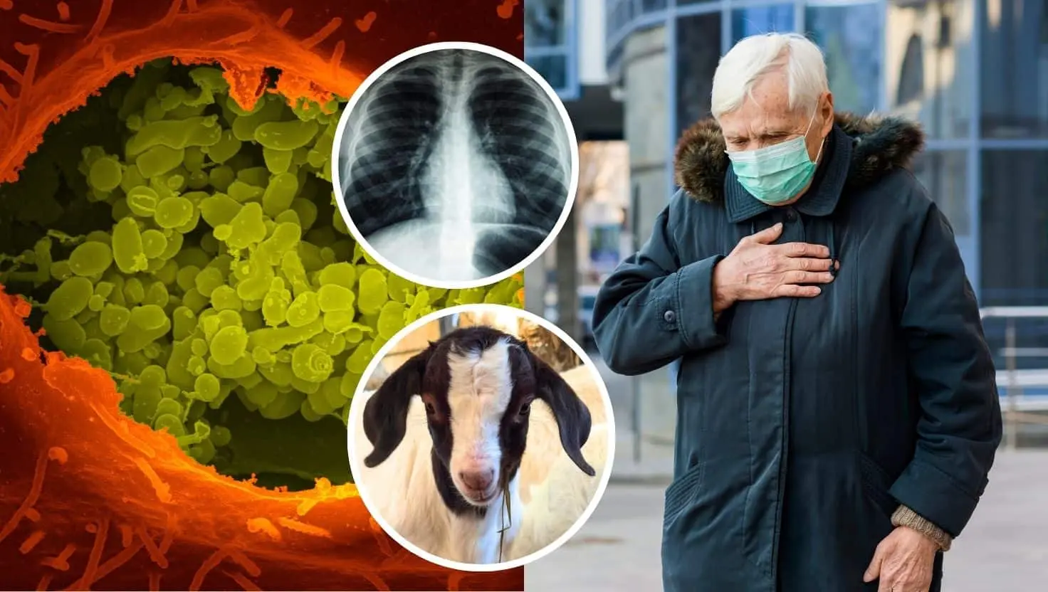 Hygienici odhalili baktériu, s ktorou sa nestretli celé desaťročia