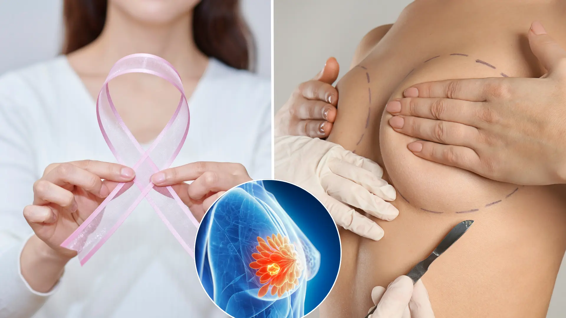 rakovina, prsník, rekonštrukcia, operácia