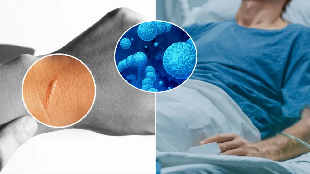 jazvy po tele muž mäsožravá baktéria