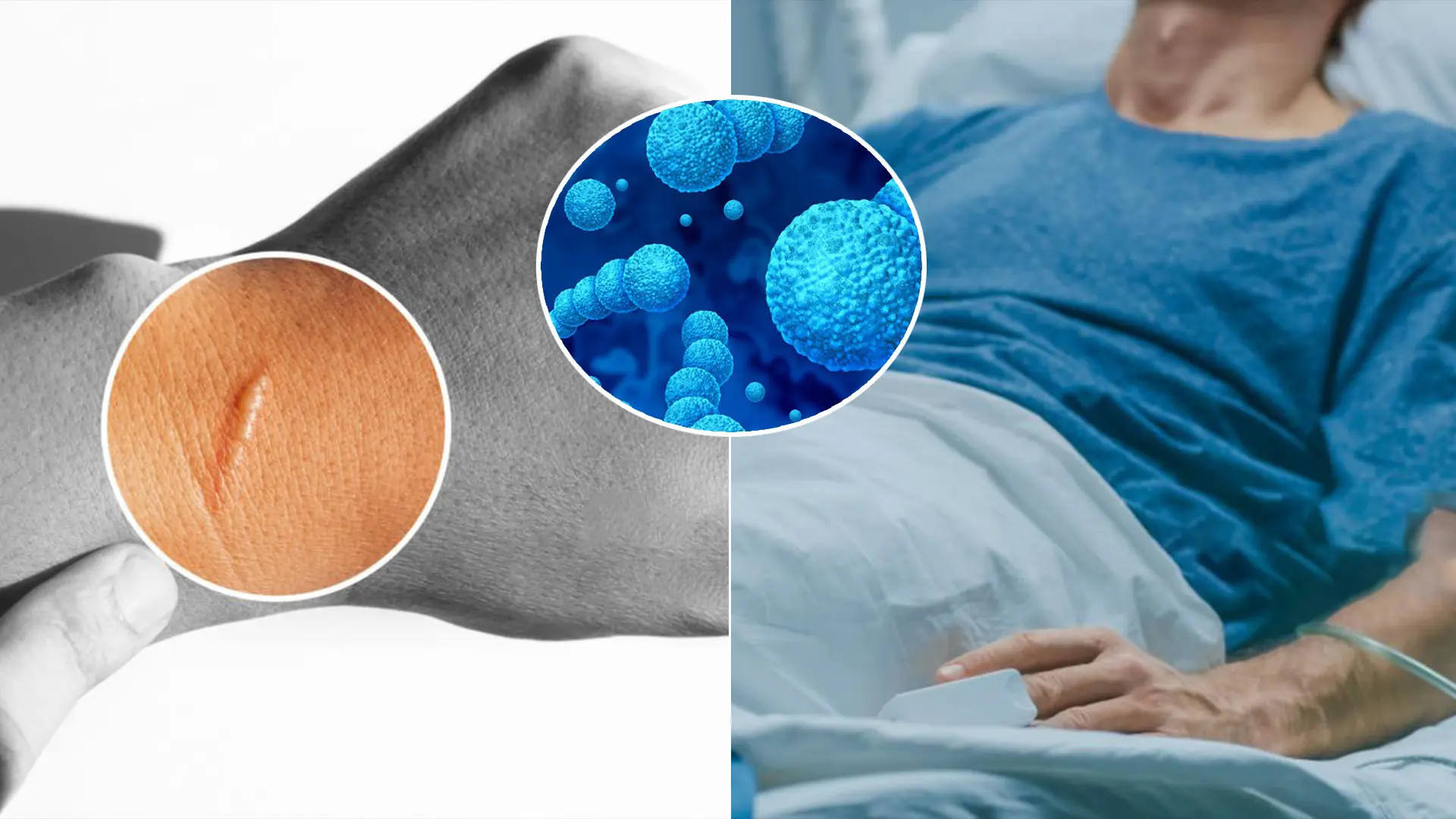 jazvy po tele muž mäsožravá baktéria