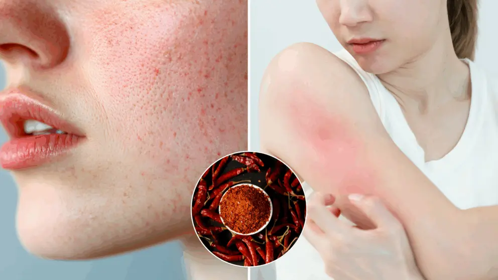 pokožka, pleč, červená, rosacea