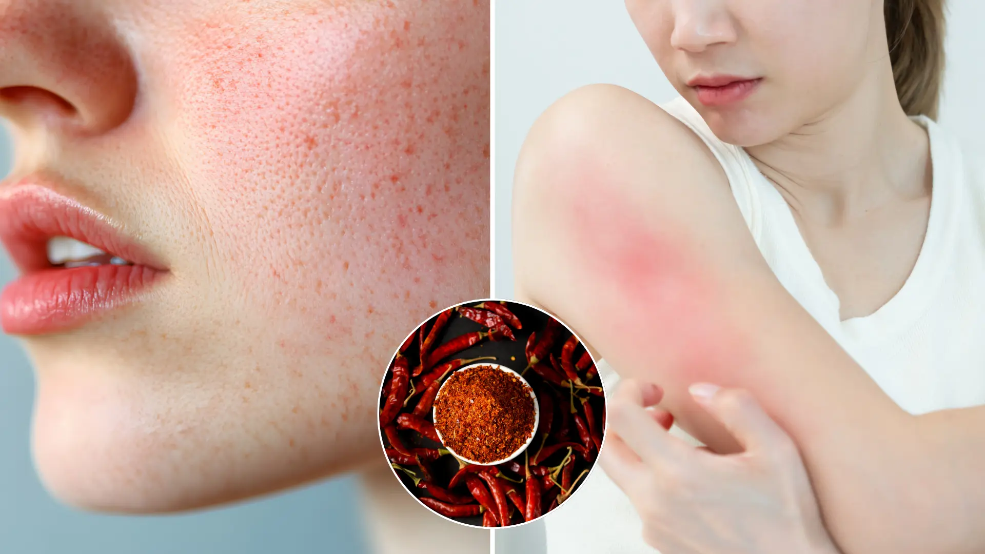 pokožka, pleč, červená, rosacea