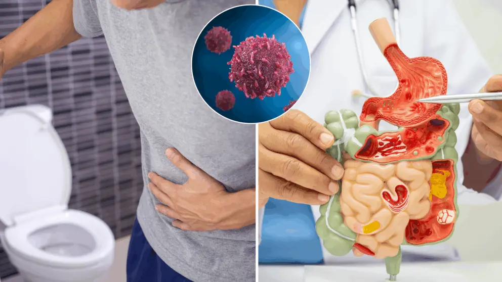 rakovina, hrubé črevo