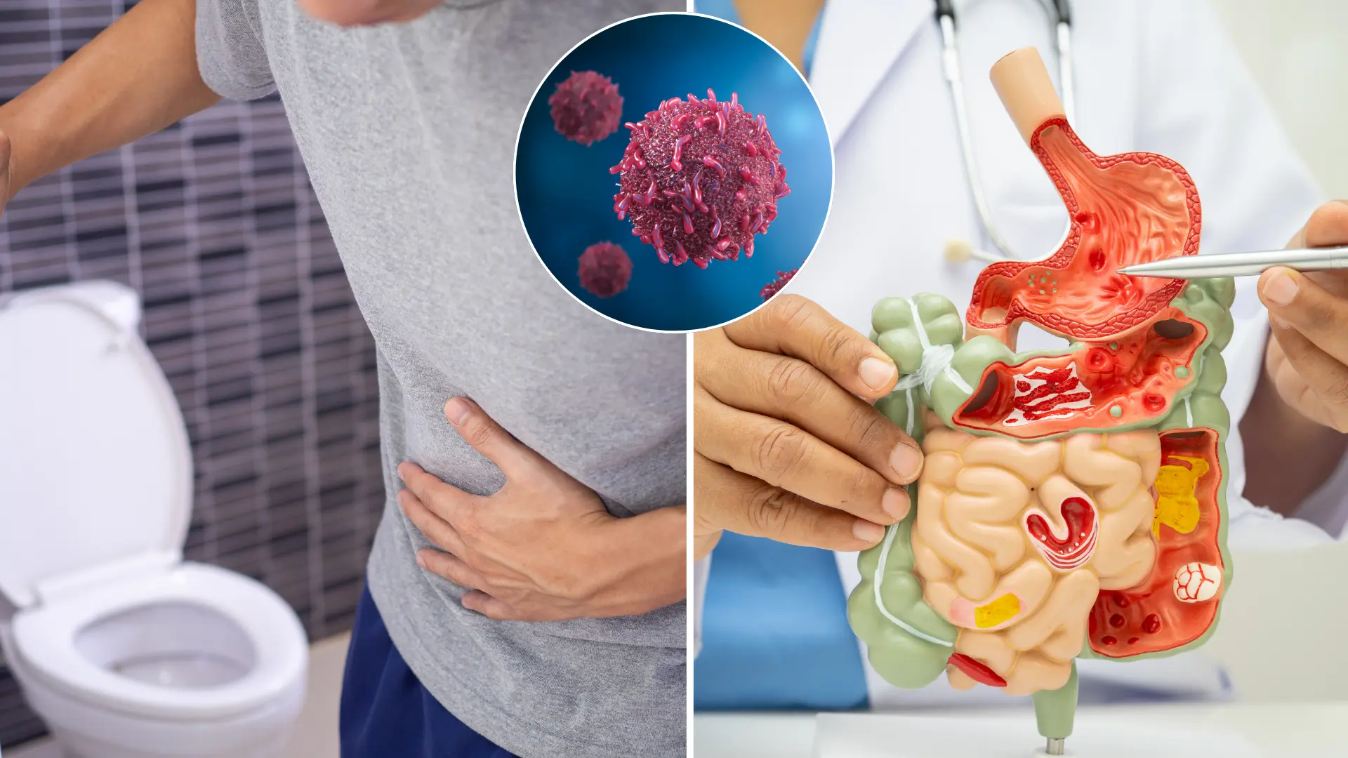 rakovina, hrubé črevo